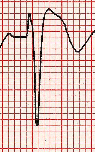 Brugada işareti Kaynak : lifeinthefastlane.com - ECG library