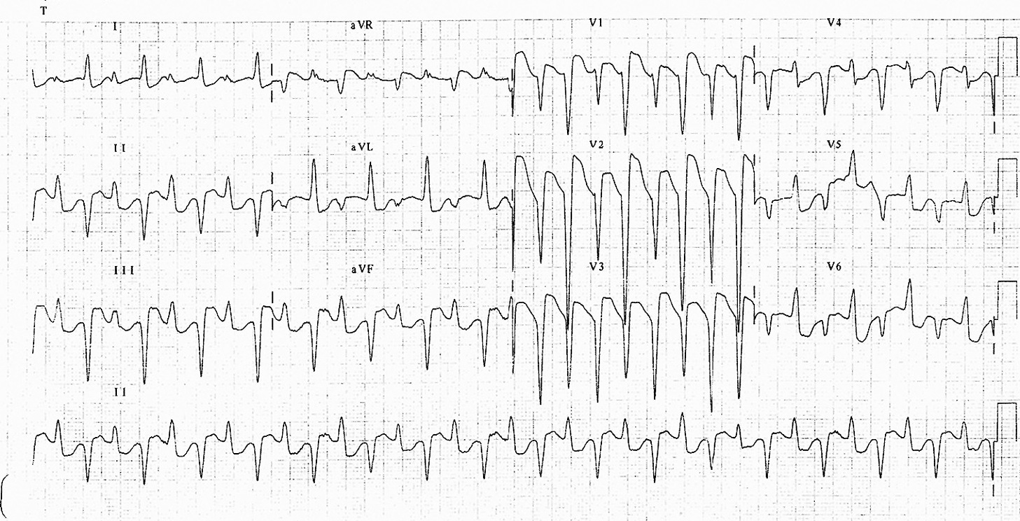 Kaynak : lifeinthefastlane.com - ECG library