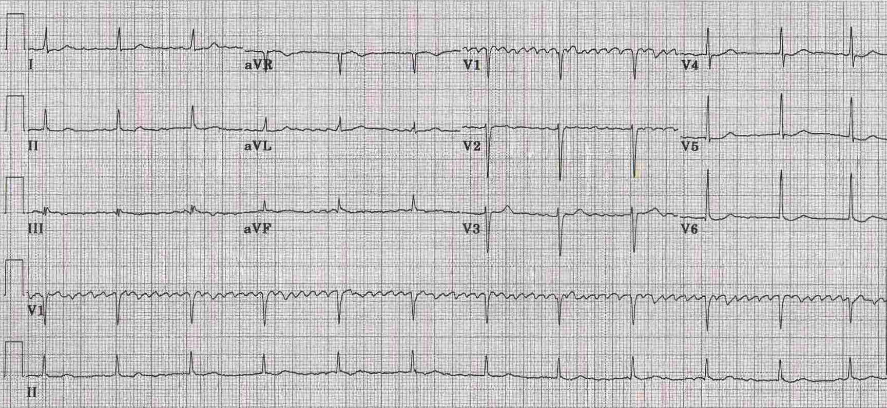 Kaynak : lifeinthefastlane.com - ECG library