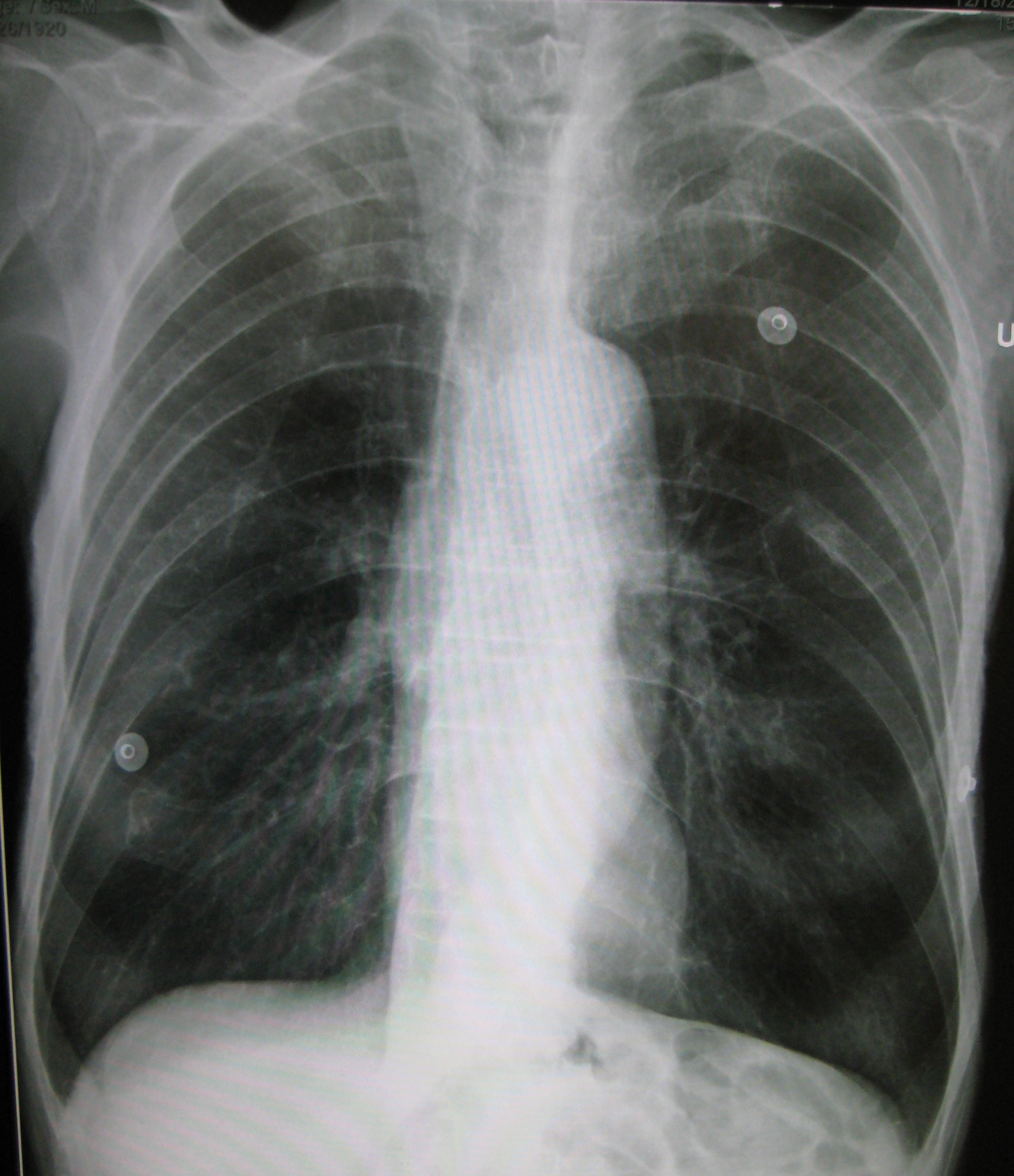 Akciğerlerin aşırı genişlemesi ve kalbin vertikale yönelmesi Kaynak : lifeinthefastlane.com - ECG library