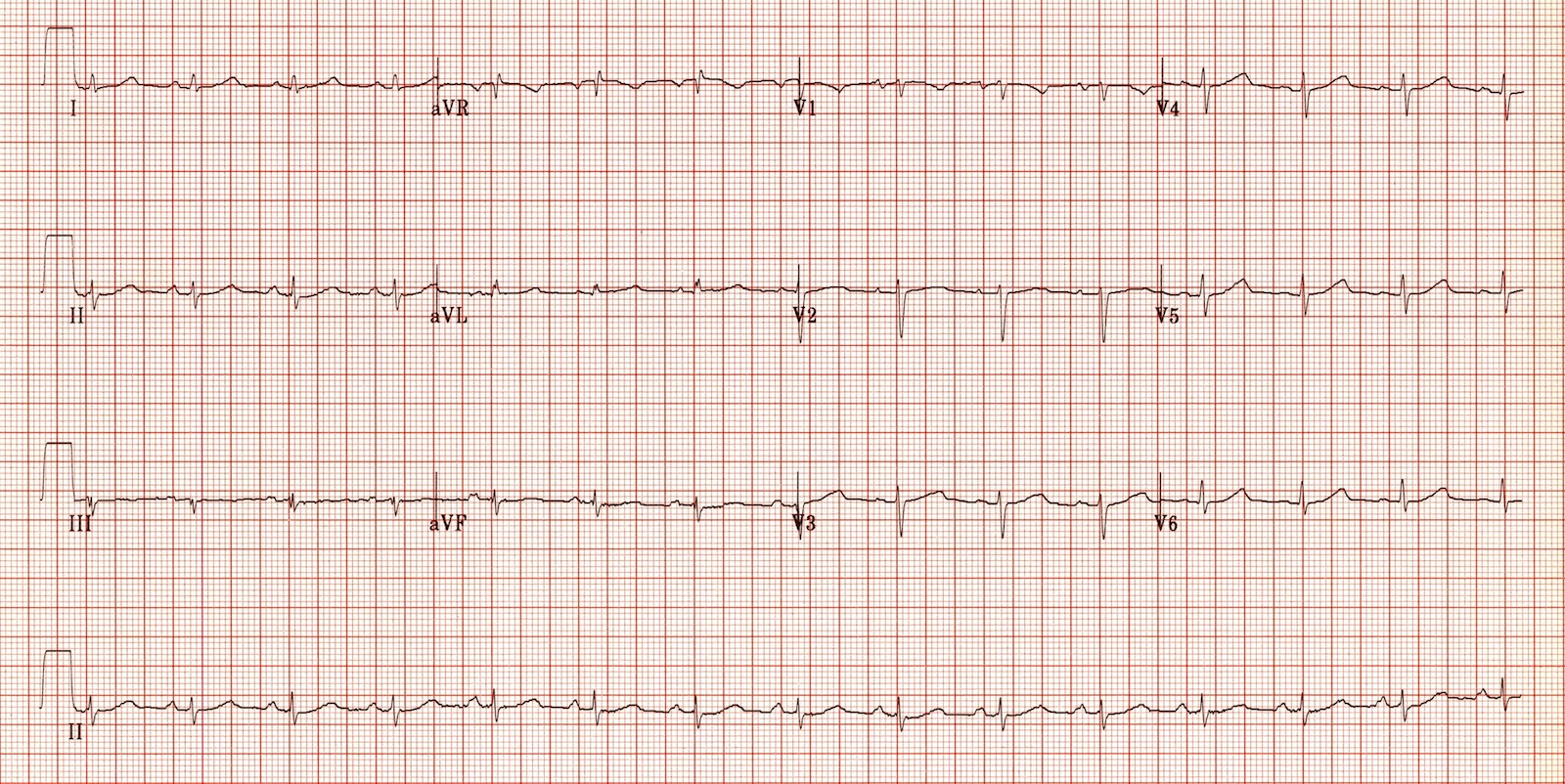 Kaynak : lifeinthefastlane.com - ECG library