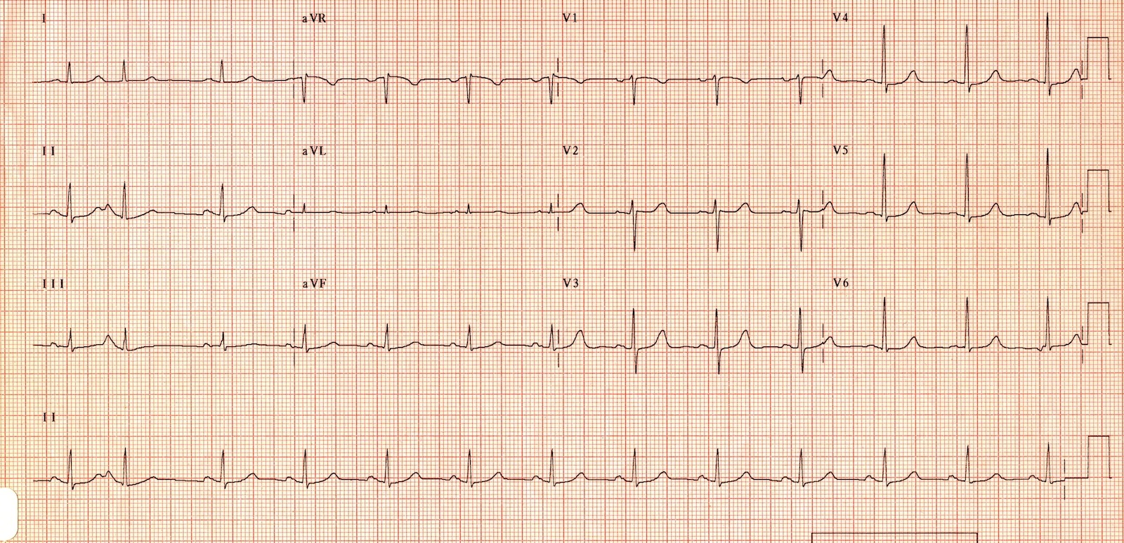 Kaynak : lifeinthefastlane.com - ECG library