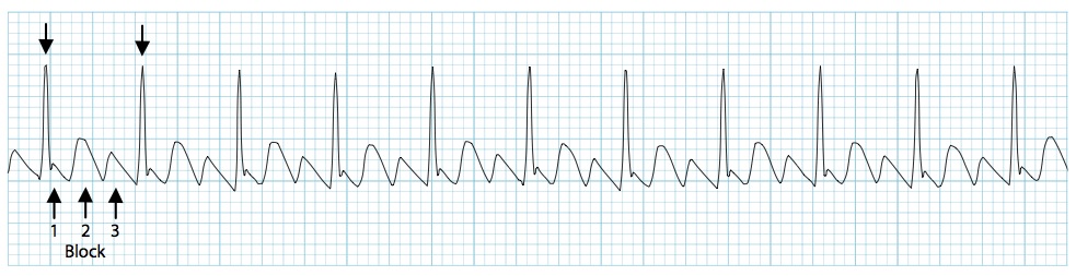 3:1 bloklu atriyal flutter Kaynak: lifeinthefastlane.com - ECG library