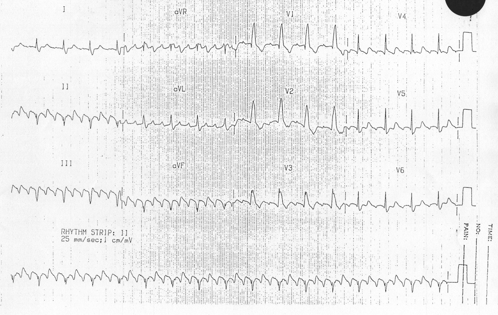 Kaynak: lifeinthefastlane.com - ECG library