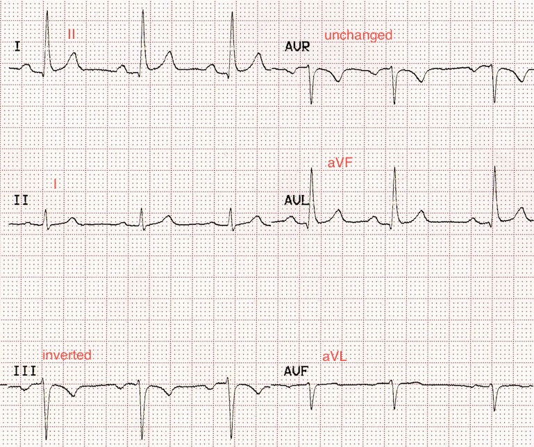 Kaynak : lifeinthefastlane.com - ECG library