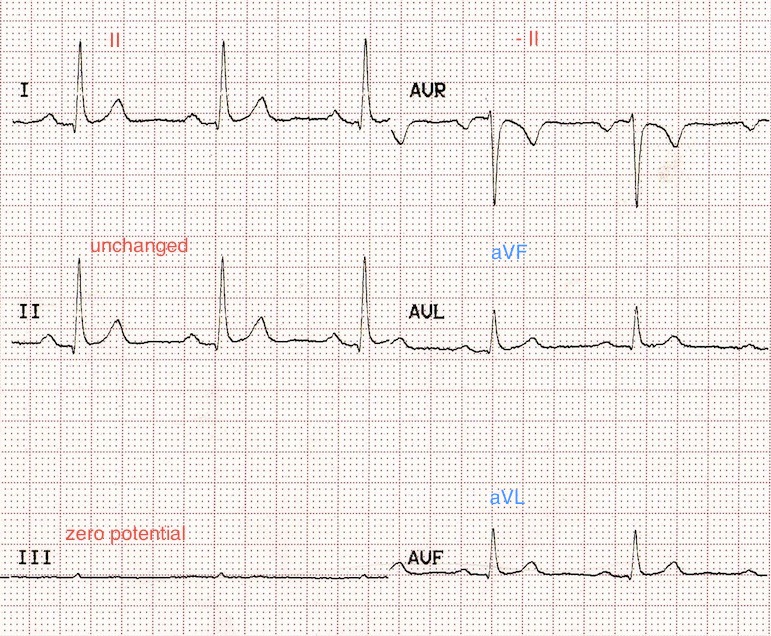 Kaynak : lifeinthefastlane.com - ECG library