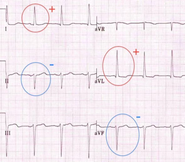 Sol Aks Sapması: I ve aVL derivasyonları pozitif; II ve aVF derivasyonları negatif. Kaynak : lifeinthefastlane.com - ECG library