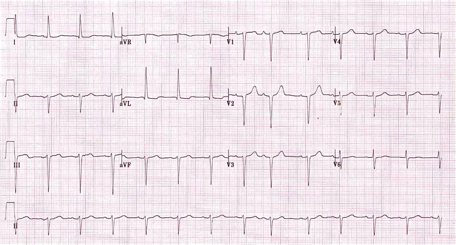I ve aVL derivasyonlarında qR kompleksleri, II, III ve aVF'de rS kompleksleri. Kaynak : lifeinthefastlane.com - ECG library
