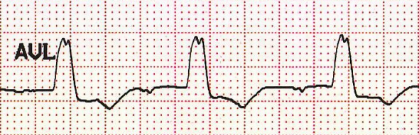 'M'-şekilli QRS kompleksi Kaynak : lifeinthefastlane.com - ECG library