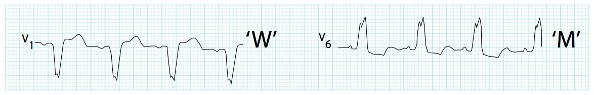 V1'de dominant S dalgası ile birlikte, V6'da geniş, çentikli ('M' şekilli) R dalgası. Kaynak : lifeinthefastlane.com - ECG library