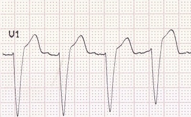 rS kompleksi ve ılımlı diskordans ile birlikte V1'de sol dal bloğunun tipik görünümü. Kaynak : lifeinthefastlane.com - ECG library