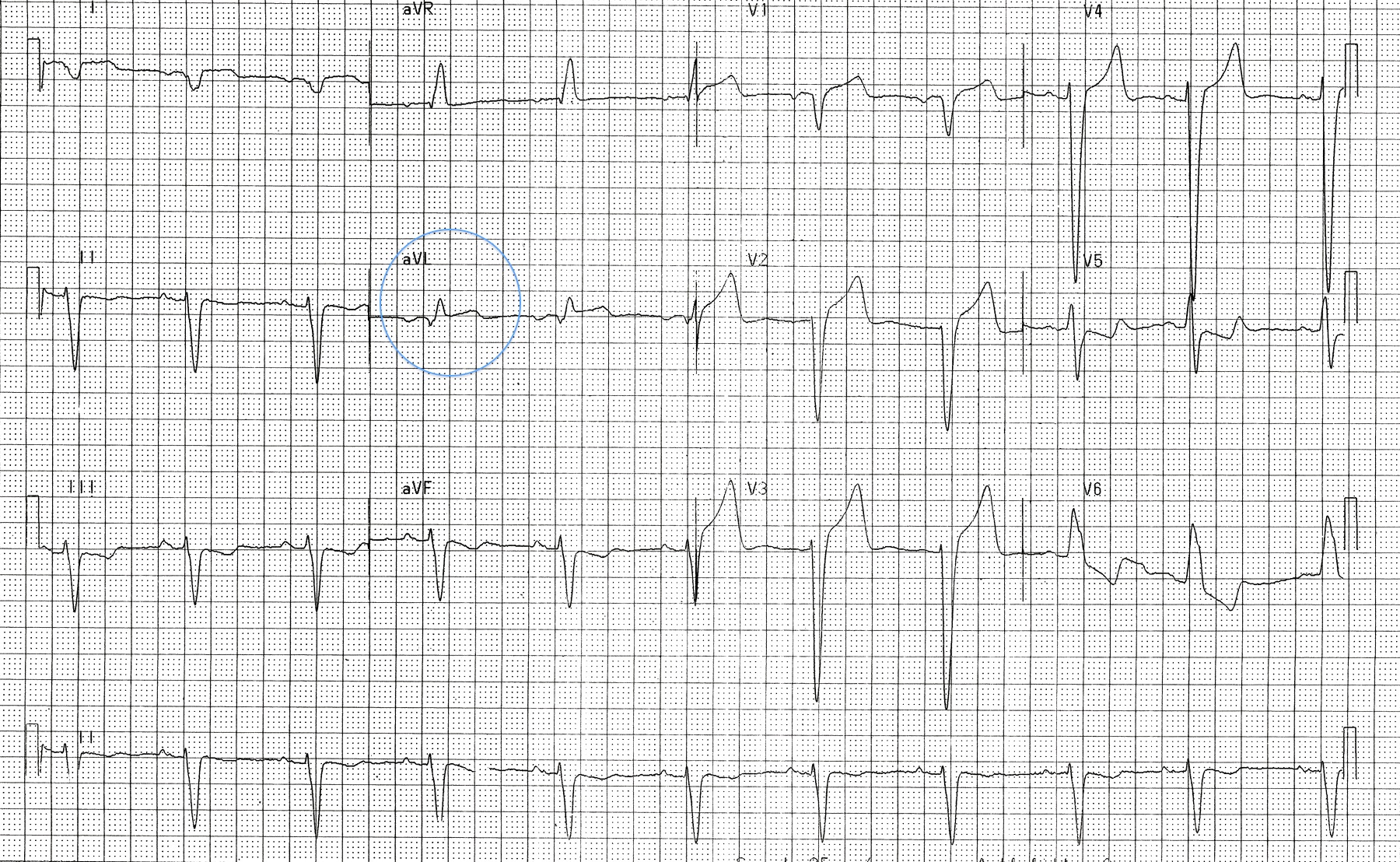 Kaynak : lifeinthefastlane.com - ECG library