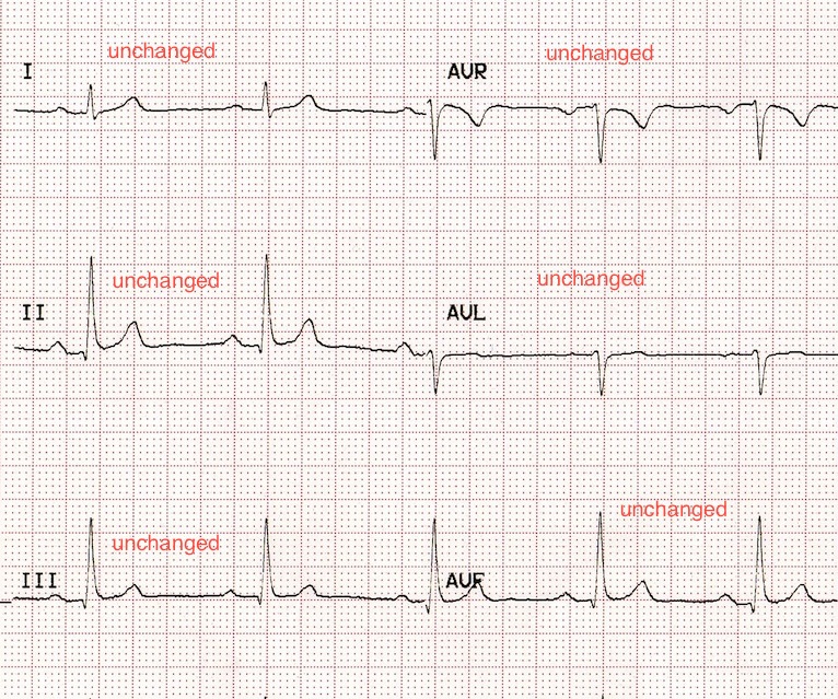 Kaynak : lifeinthefastlane.com - ECG library