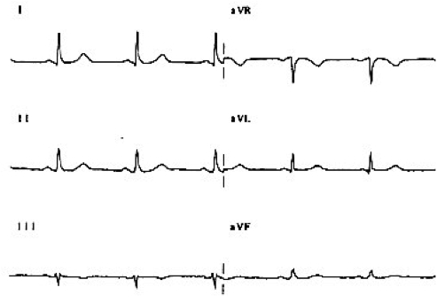 LA/RA yer değişimi düzeltilmiş. Kaynak : lifeinthefastlane.com - ECG library