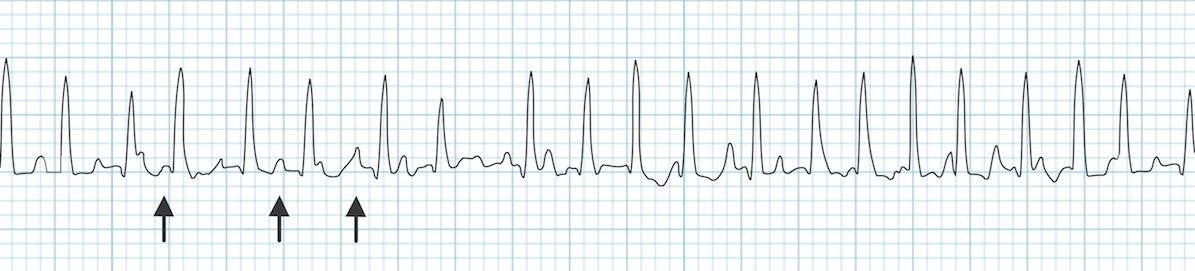 Multifokal atriyal taşikardi: En az üç farklı P dalga morfolojisi ile birlikte hızlı, dar kompleks ritm(oklar). Kaynak : lifeinthefastlane.com - ECG library