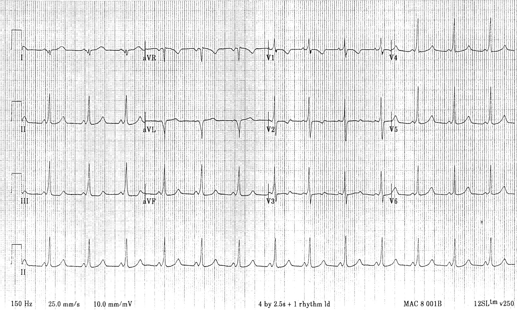 Kaynak : lifeinthefastlane.com - ECG library