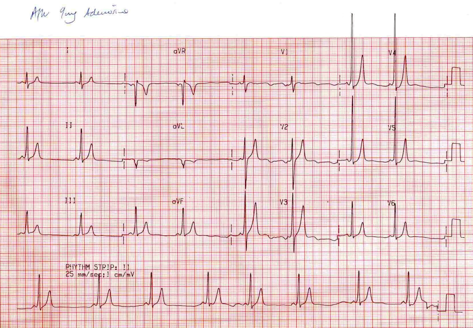 Kaynak : lifeinthefastlane.com - ECG library