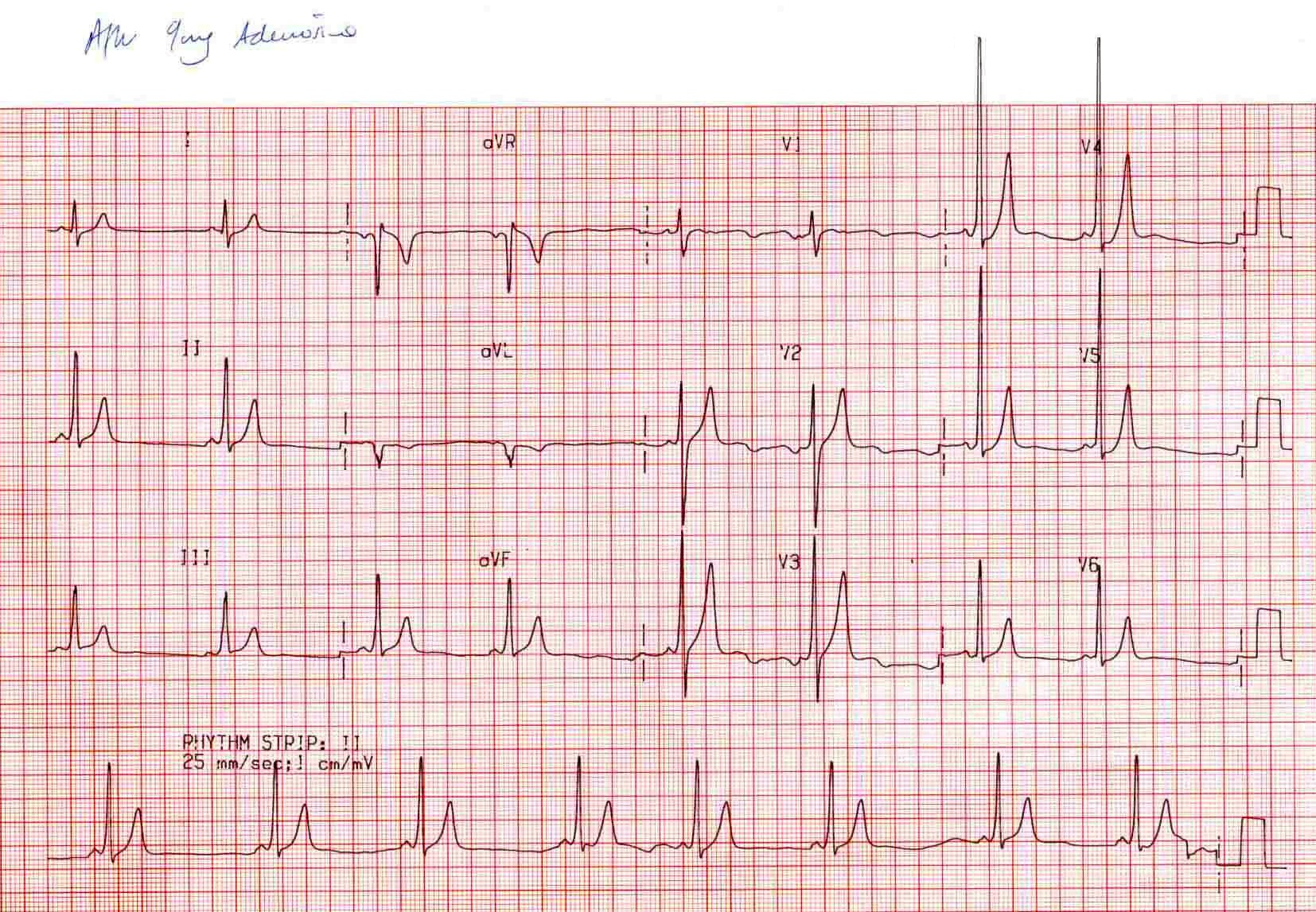 Kaynak : lifeinthefastlane.com - ECG library