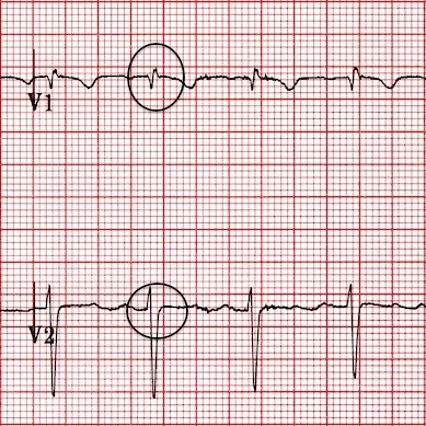 V1-2'deki yalancı R' dalgaları düzelmiş. Kaynak : lifeinthefastlane.com - ECG library