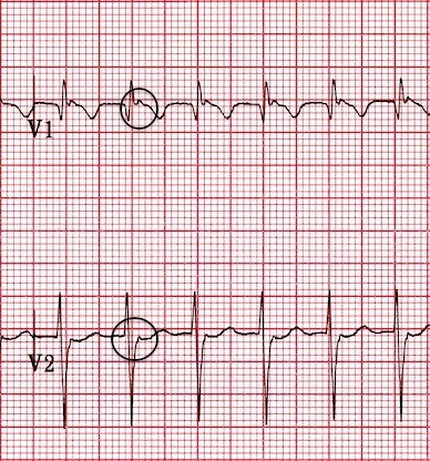 V1-2'de yalancı R' dalgaları Kaynak : lifeinthefastlane.com - ECG library
