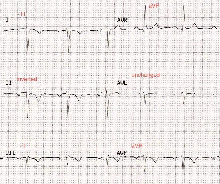 Kayn : lifeinthefastlane.com - ECG library
