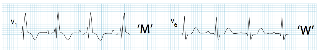 V6'da geniş, uzamış S dalgası ("W" patterni) ile birlikte V1'de uzun R' dalgaları ("M" patterni). Kaynak : lifeinthefastlane.com - ECG libary