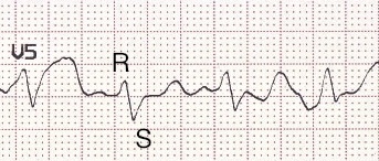 RS kompleksi Kaynak : lifeinthefastlane.com - ECG library