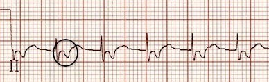 II. derivasyonda ters P dalgaları Kaynak : lifeinthefastlane.com - ECG library