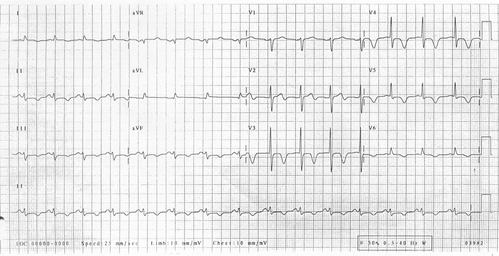 Kaynak : lifeinthefastlane.com - ECG library