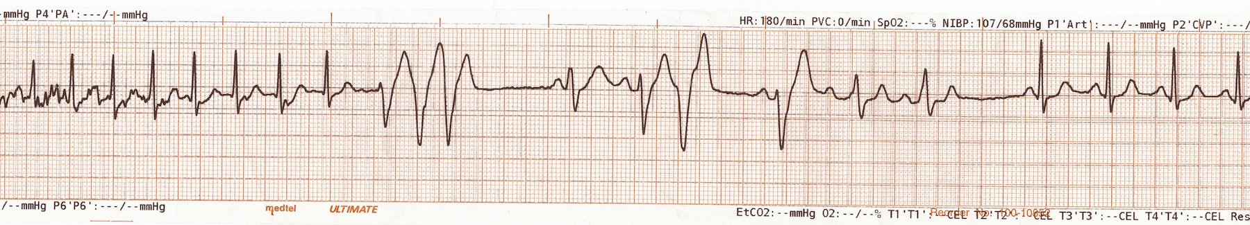 Bolus adenozinden sonra sinüs ritmine dönen AVNRT Kaynak: lifeinthefastlane.com - ECG library