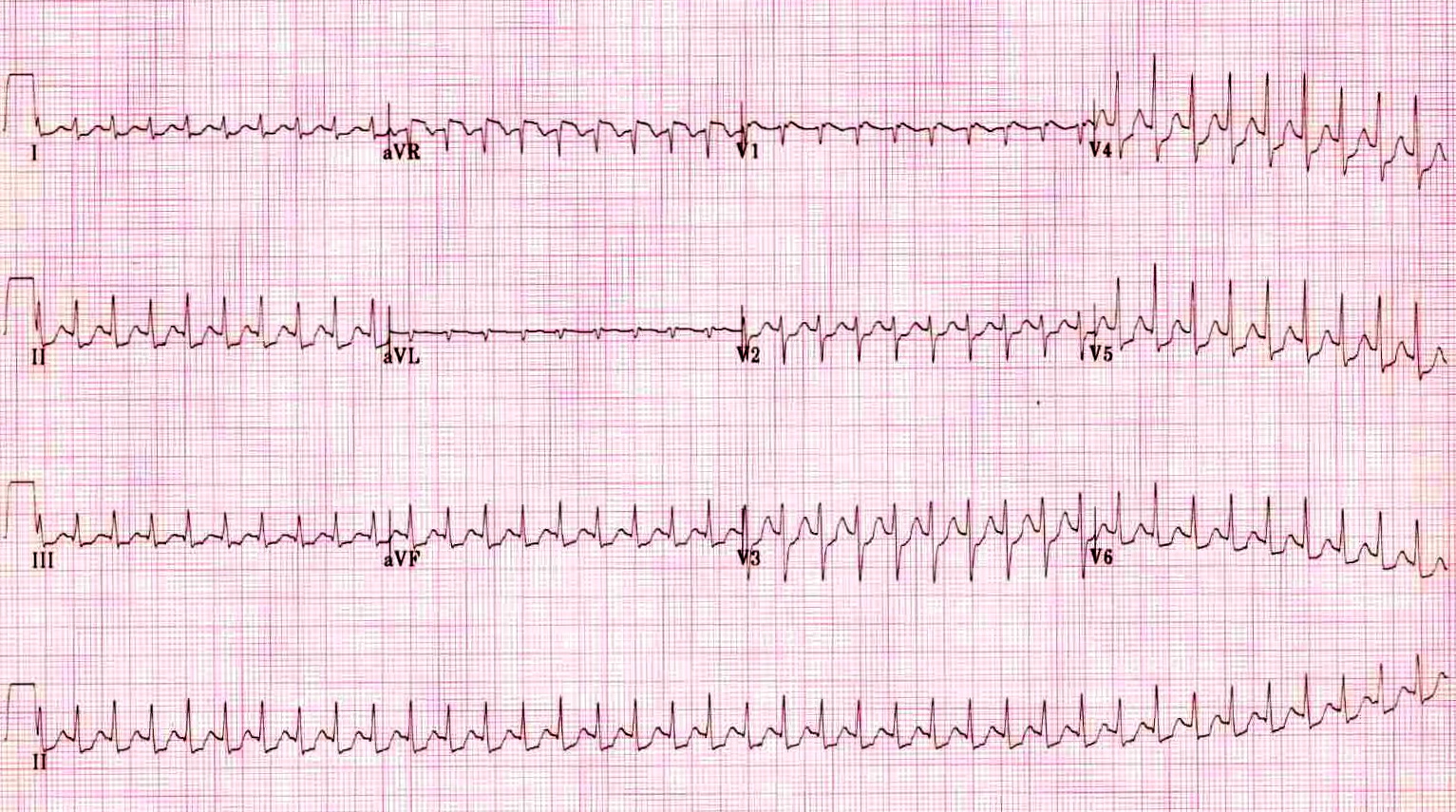 Kaynak : lifeinthefastlane.com - ECG library