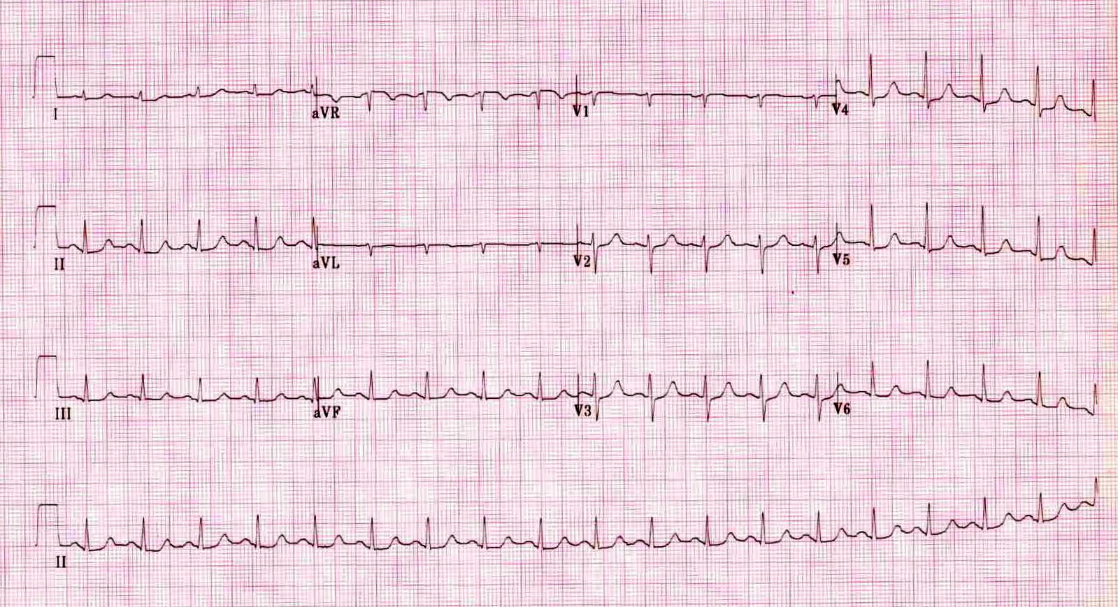 Kaynak : lifeinthefastlane.com - ECG library