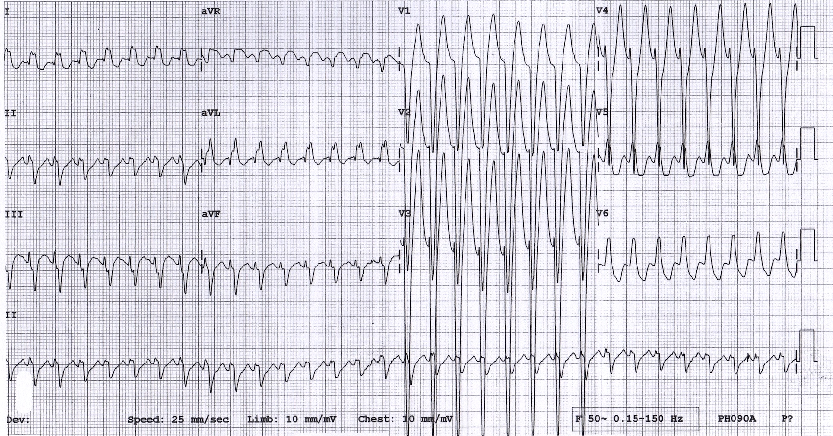 Kaynak : lifeinthefastlane.com - ECG library