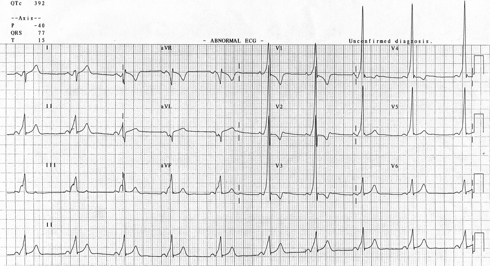 Kaynak : lifeinthefastlane.com - ECG library