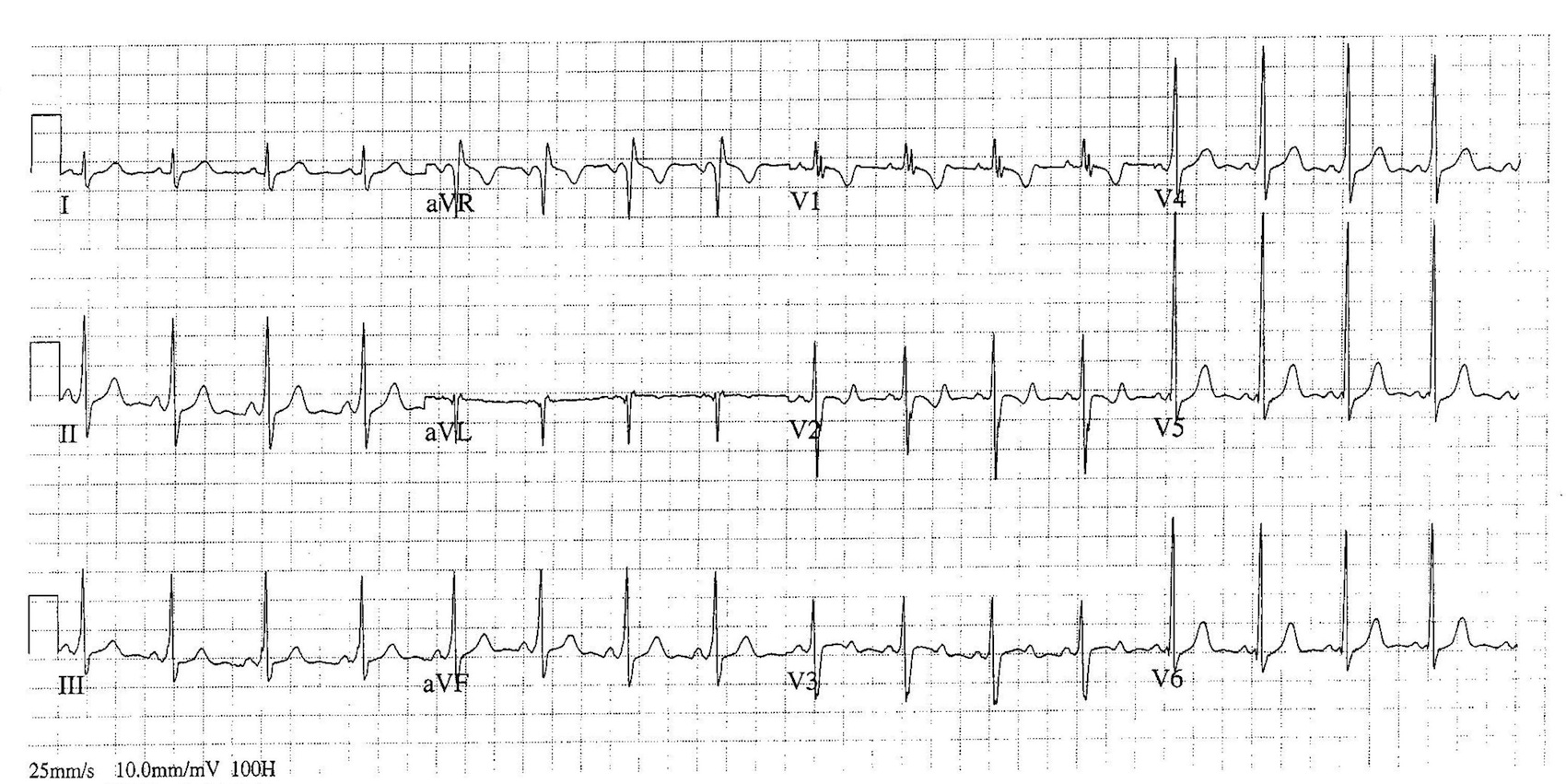 Kaynak : lifeinthefastlane.com - ECG library