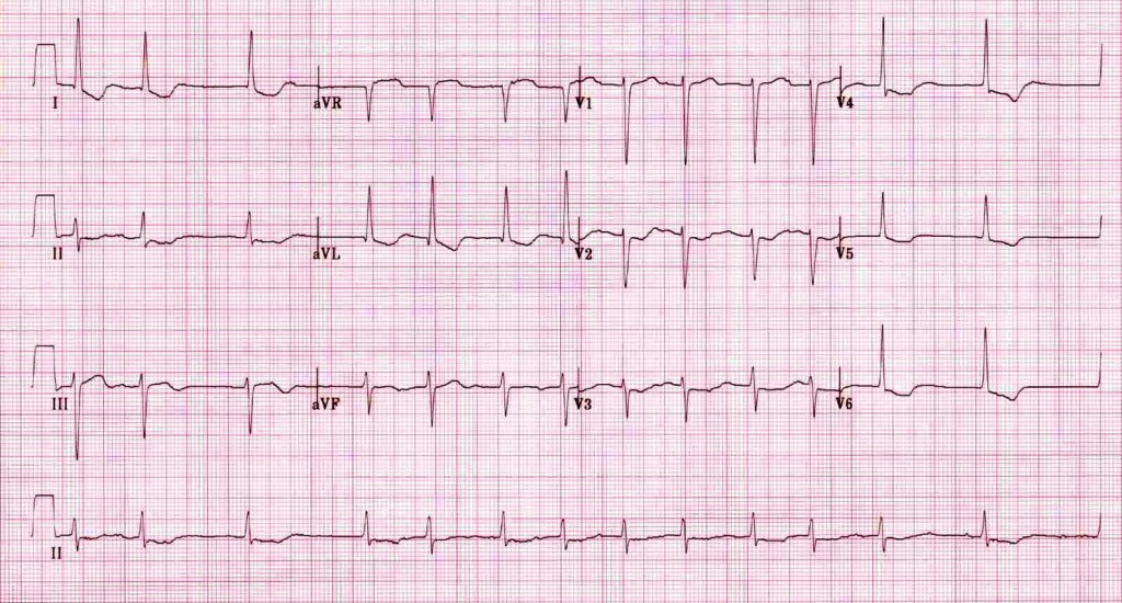 Kaynak : lifeinthefastlane.com - ECG library