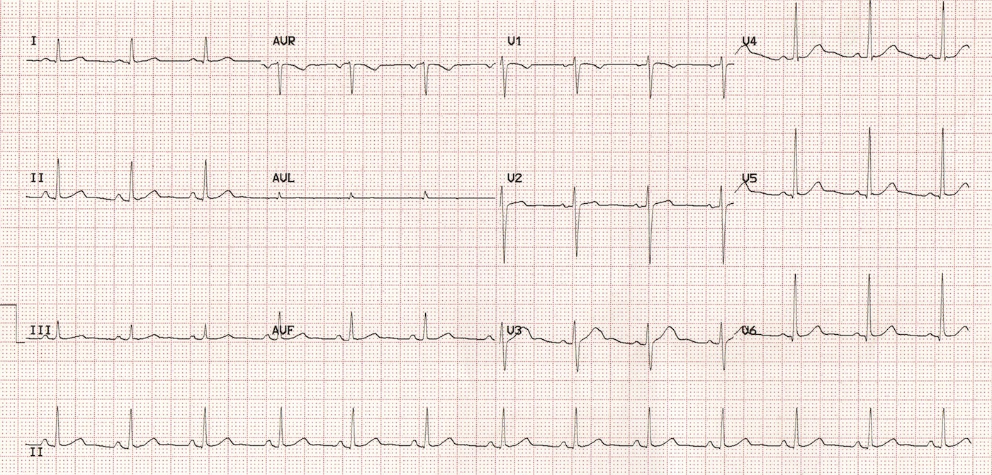 Kaynak : lifeinthefastlane.com - ECG library