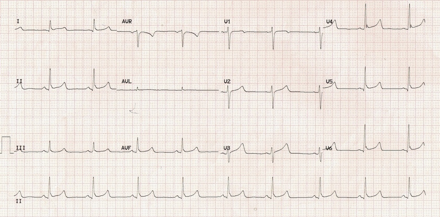 Kaynak : lifeinthefastlane.com - ECG library