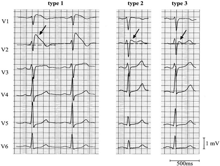 Farklı Brugada EKG patternlerinin karşılaştırılması Kaynak : lifeinthefastlane.com - ECG library