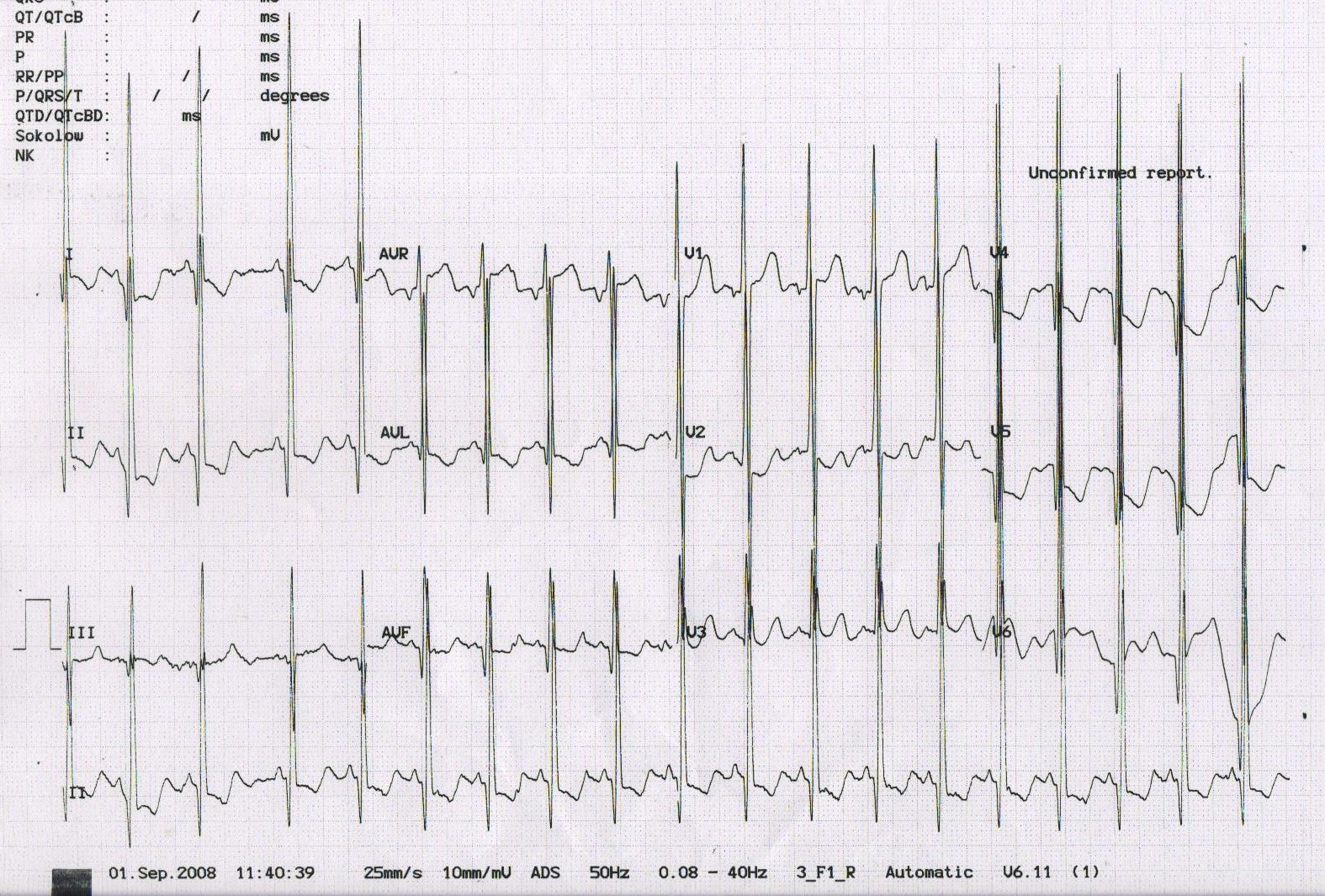 Kaynak : lifeinthefastlane.com - ECG library