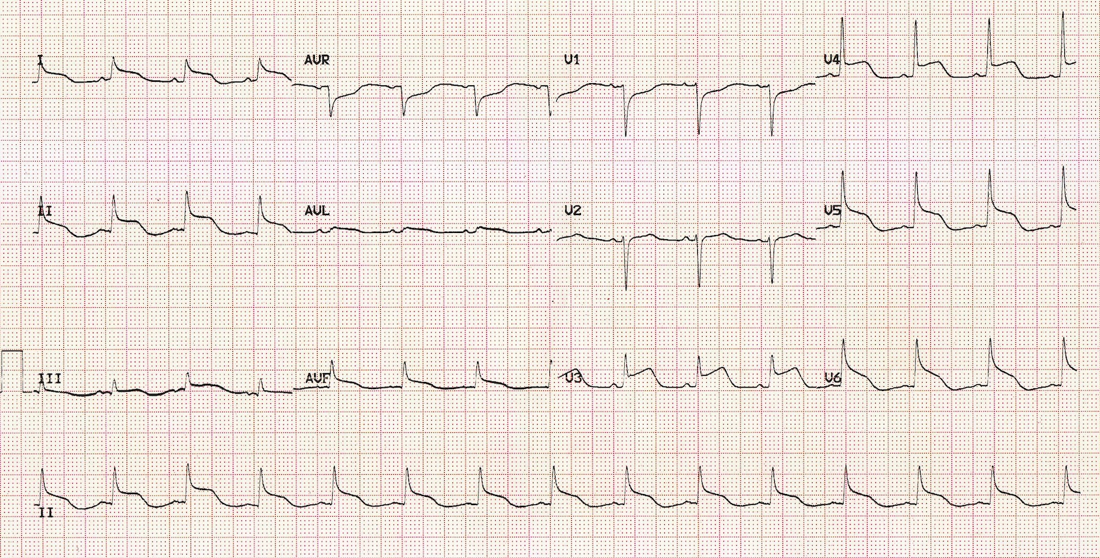 Kaynak : lifeinthefastlane.com - ECG libary