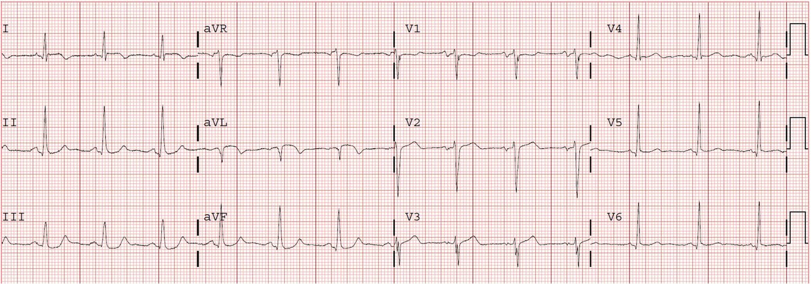Kaynak : lifeinthefastlane.com - ECG library