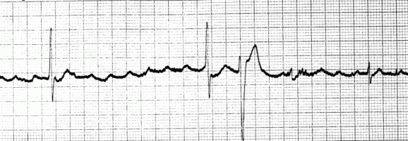 Kaynak : lifeinthefastlane.com - ECG library