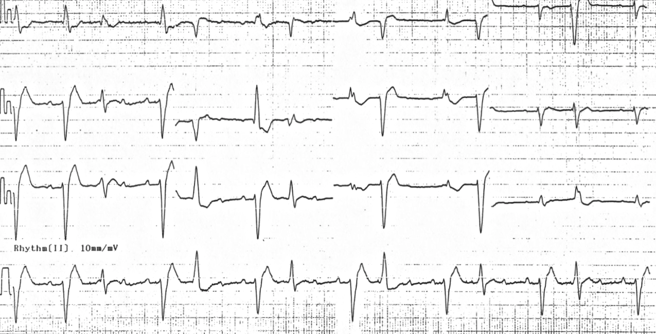 Kaynak : lifeinthefastlane.com - ECG library