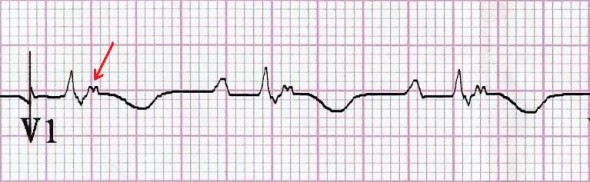 Aritmojenik Sağ Ventriküler Displazi (ARVD) 2 V1'de epsilon dalgası Kaynak: lifeinthefastlane.com - ECG library