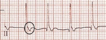 II. derivasyonda ters retrograd P dalgaları. Kaynak : lifeinthefastlane.com - ECG library