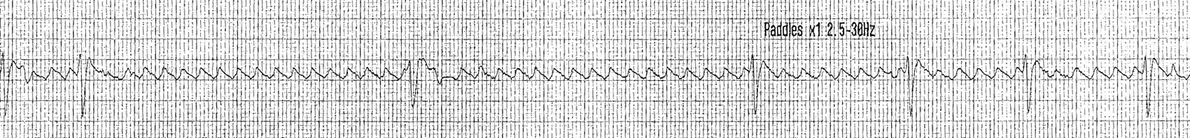 Adenozin ile açığa çıkan flutter dalgaları Kaynak: lifeinthefastlane.com - ECG library