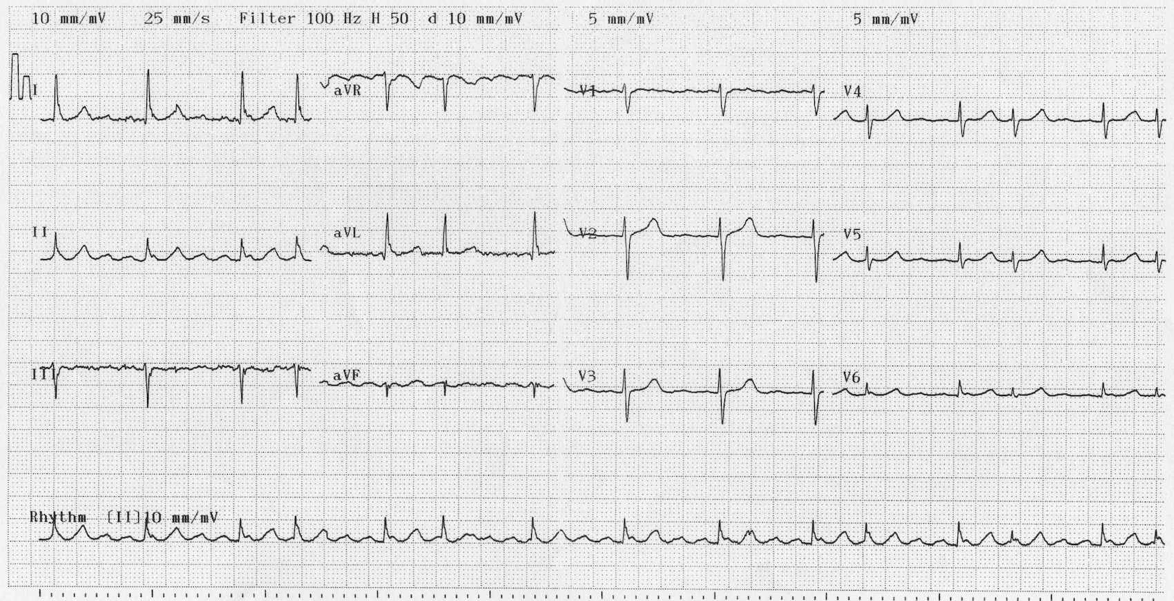 Kaynak: lifeinthefastlane.com - ECG library