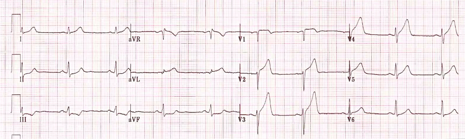 Kaynak : lifeinthefastlane.com - ECG library