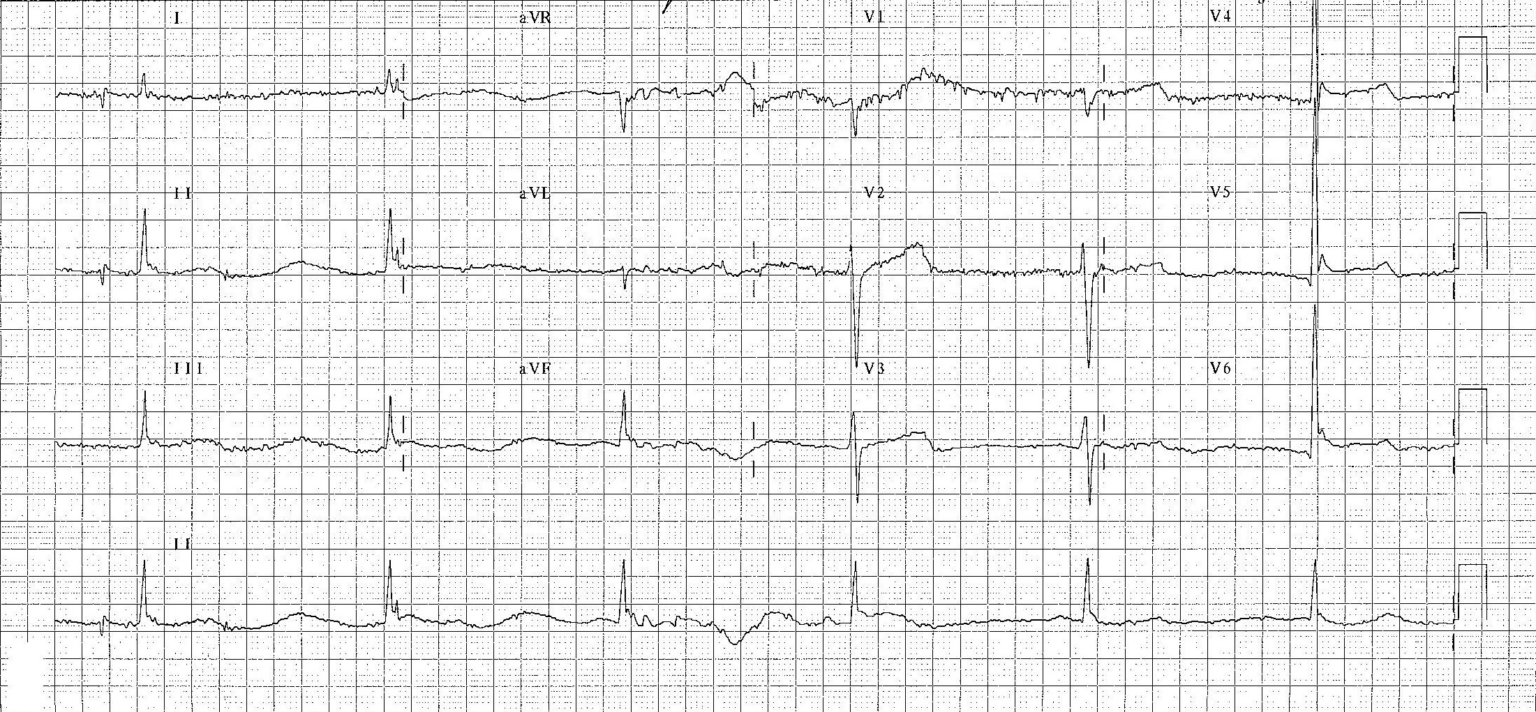 Bu EKG hipoterminin klasik özelliklerini göstermektedir : bradikardi, Osborn dalgaları ve titreme artefaktı
